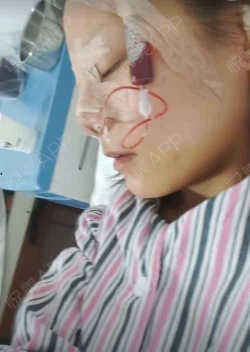 做假体隆鼻视频,视频带你领略美丽蜕变之旅